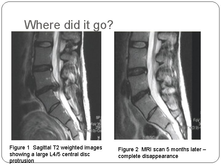 Where did it go? Figure 1 Sagittal T 2 weighted images showing a large