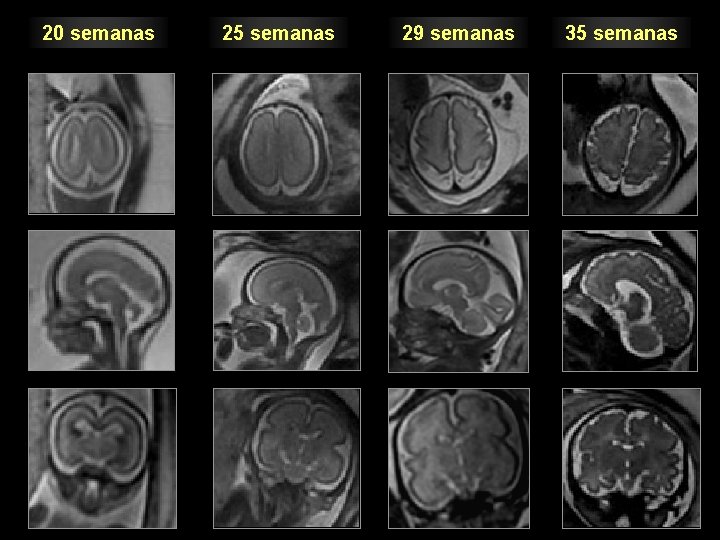 20 semanas QUÉ BUSCAR (análisis del giro) 25 semanas 29 semanas 35 semanas 