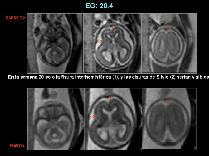 EG: 20. 4 SSFSE T 2 1 1 2 En la semana 20 solo