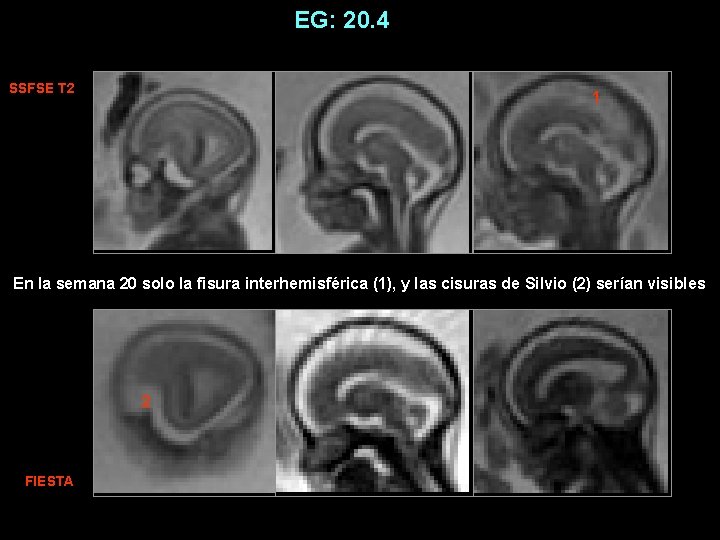 EG: 20. 4 SSFSE T 2 1 En la semana 20 solo la fisura