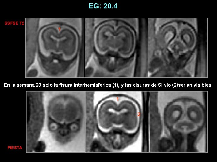 EG: 20. 4 SSFSE T 2 1 En la semana 20 solo la fisura