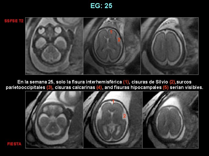 EG: 25 SSFSE T 2 1 2 En la semana 25, solo la fisura