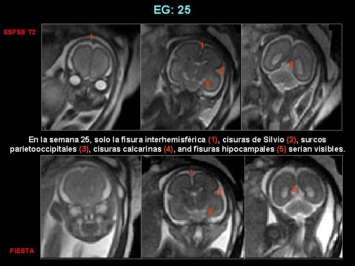 EG: 25 SSFSE T 2 1 1 2 3 5 En la semana 25,