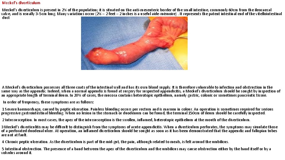 Meckel’s diverticulum is present in 2% of the population; it is situated on the