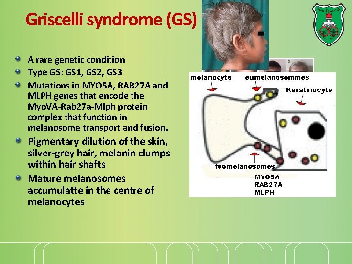 Griscelli syndrome (GS) A rare genetic condition Type GS: GS 1, GS 2, GS