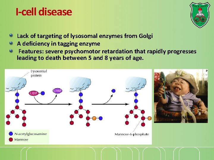 I-cell disease Lack of targeting of lysosomal enzymes from Golgi A deficiency in tagging