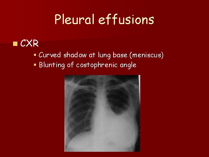 Pleural effusions n CXR § Curved shadow at lung base (meniscus) § Blunting of