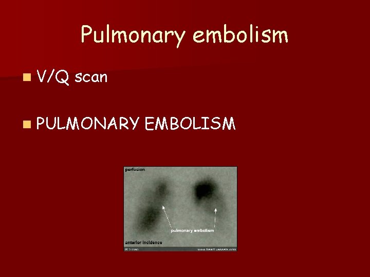 Pulmonary embolism n V/Q scan n PULMONARY EMBOLISM 