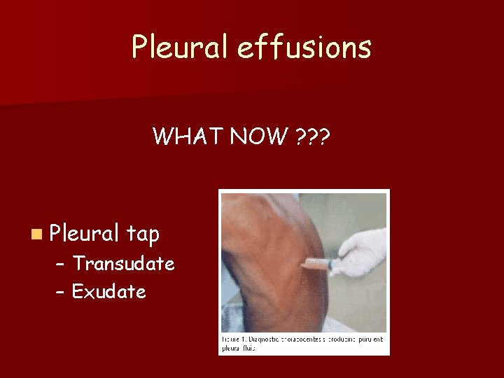 Pleural effusions WHAT NOW ? ? ? n Pleural tap – Transudate – Exudate