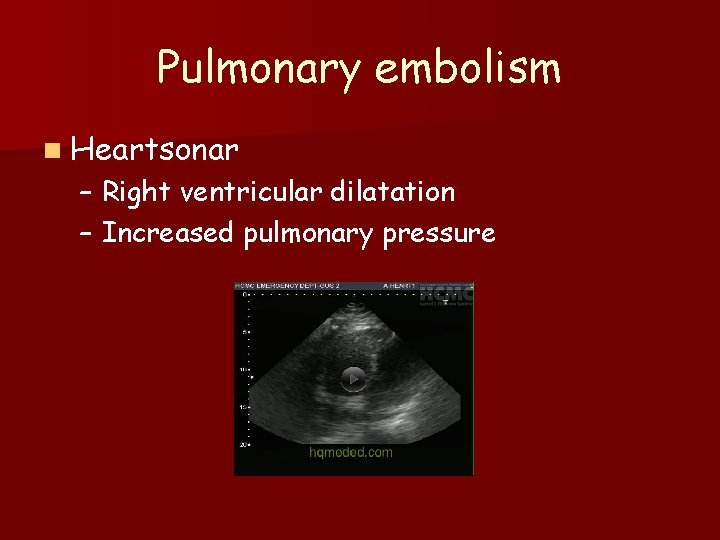 Pulmonary embolism n Heartsonar – Right ventricular dilatation – Increased pulmonary pressure 