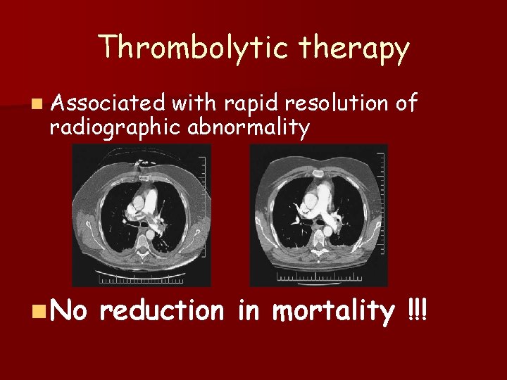 Thrombolytic therapy n Associated with rapid resolution of radiographic abnormality n No reduction in