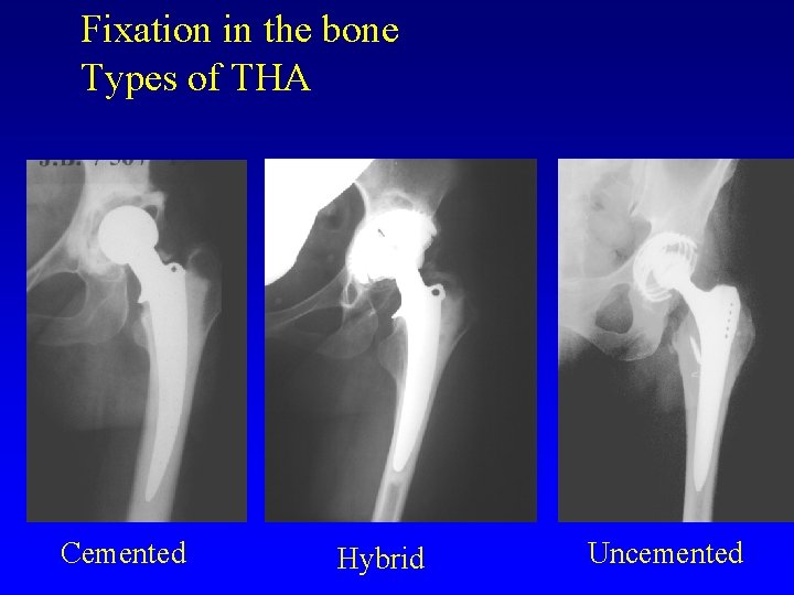 Fixation in the bone Types of THA Cemented Hybrid Uncemented 