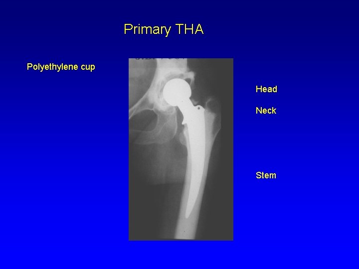 Primary THA Polyethylene cup Head Neck Stem 