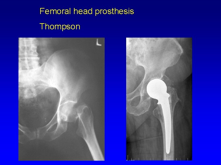 Femoral head prosthesis Thompson 