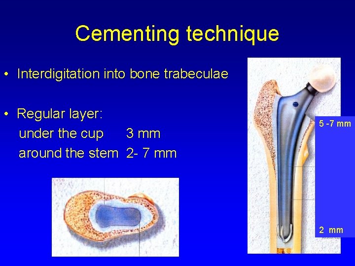 Cementing technique • Interdigitation into bone trabeculae • Regular layer: under the cup 3