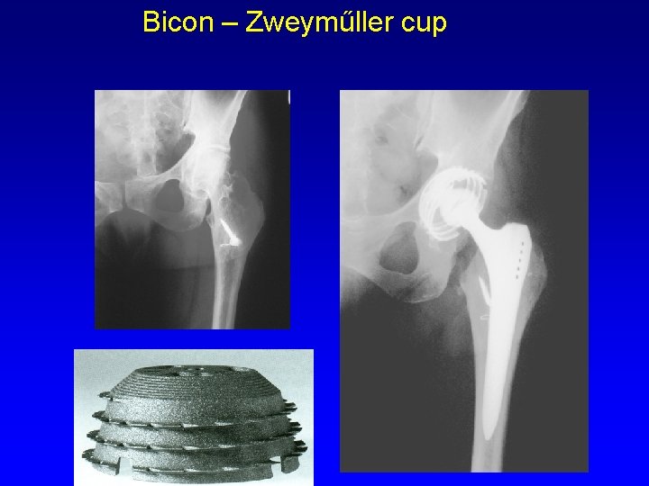 Bicon – Zweyműller cup 