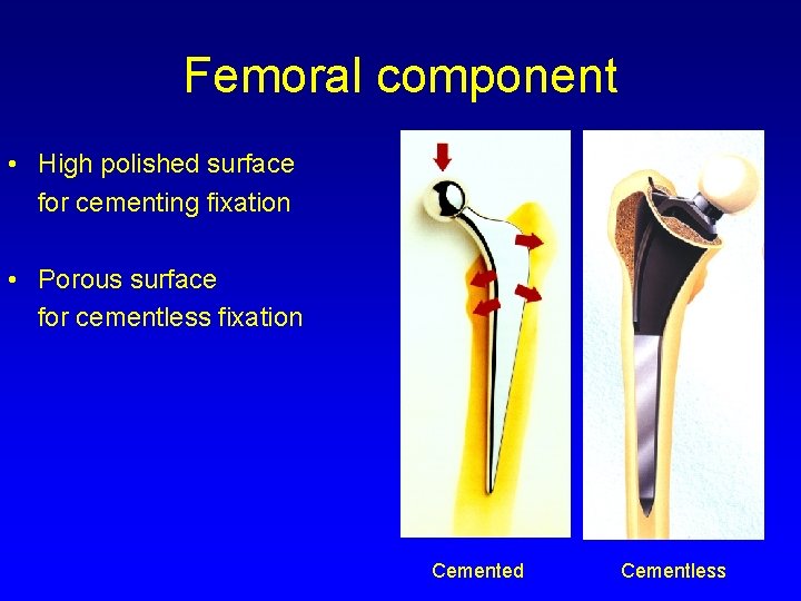 Femoral component • High polished surface for cementing fixation • Porous surface for cementless