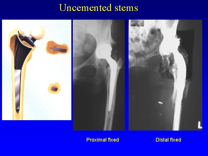 Uncemented stems Proximal fixed Distal fixed 