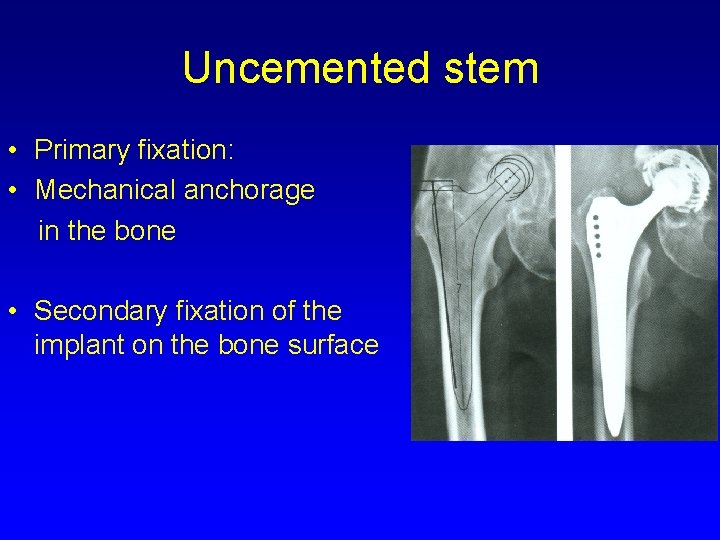 Uncemented stem • Primary fixation: • Mechanical anchorage in the bone • Secondary fixation