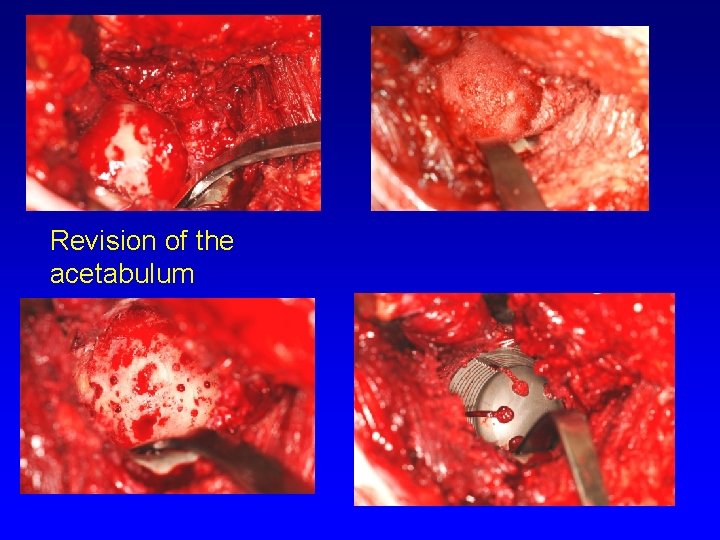 Revision of the acetabulum 