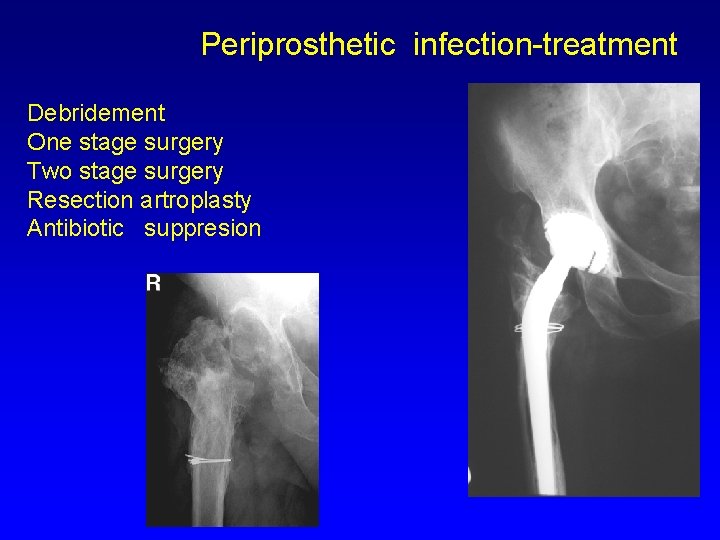 Periprosthetic infection-treatment Debridement One stage surgery Two stage surgery Resection artroplasty Antibiotic suppresion 