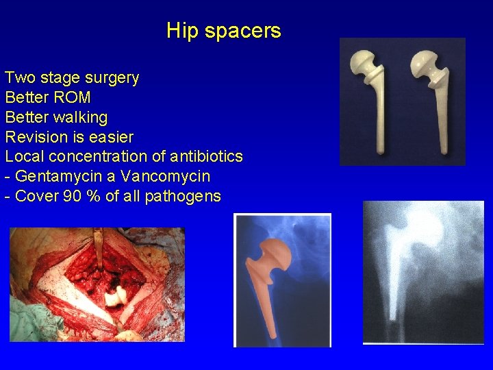 Hip spacers Two stage surgery Better ROM Better walking Revision is easier Local concentration