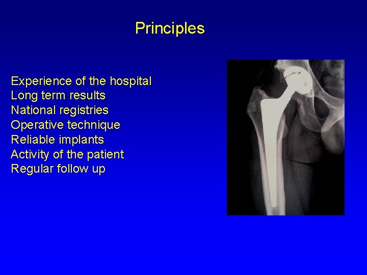 Principles Experience of the hospital Long term results National registries Operative technique Reliable implants