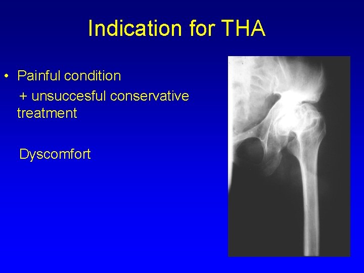 Indication for THA • Painful condition + unsuccesful conservative treatment Dyscomfort 
