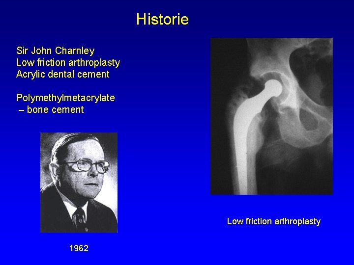 Historie Sir John Charnley Low friction arthroplasty Acrylic dental cement Polymethylmetacrylate – bone cement