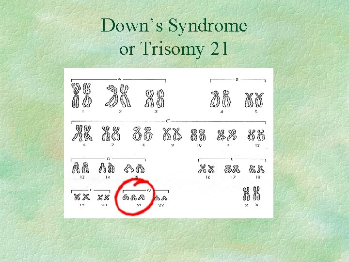 Down’s Syndrome or Trisomy 21 