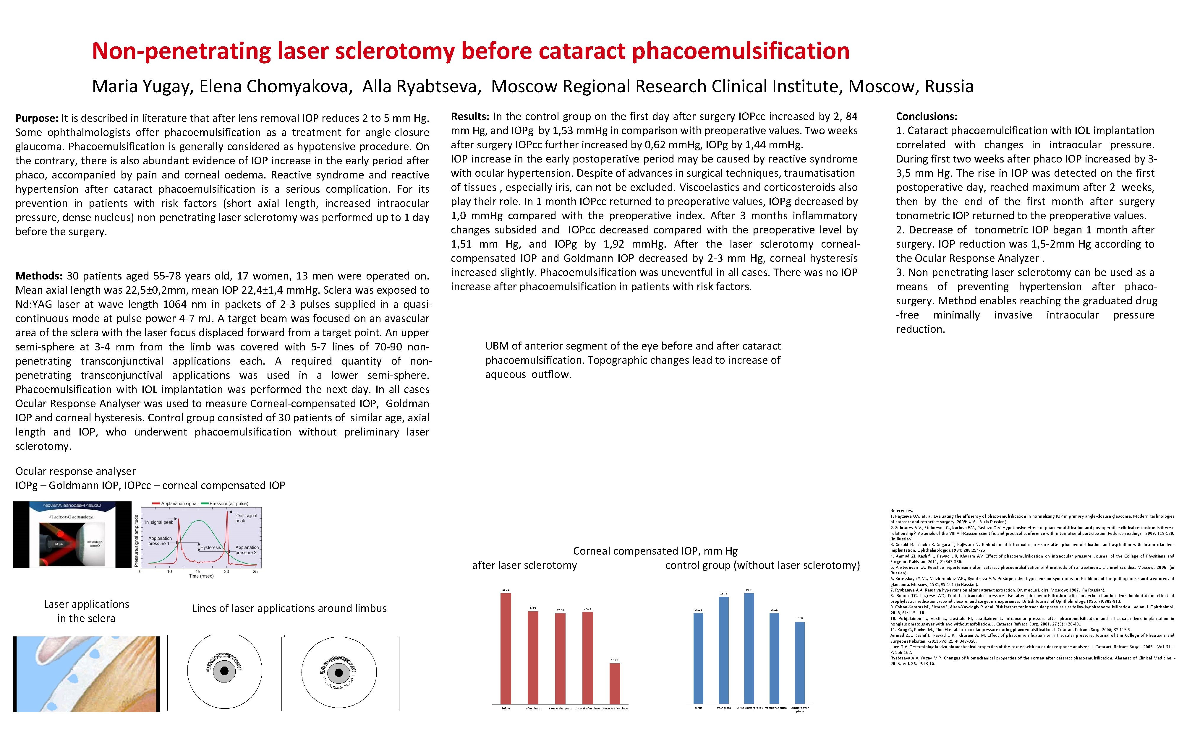 Non-penetrating laser sclerotomy before cataract phacoemulsification Maria Yugay, Elena Chomyakova, Alla Ryabtseva, Moscow Regional