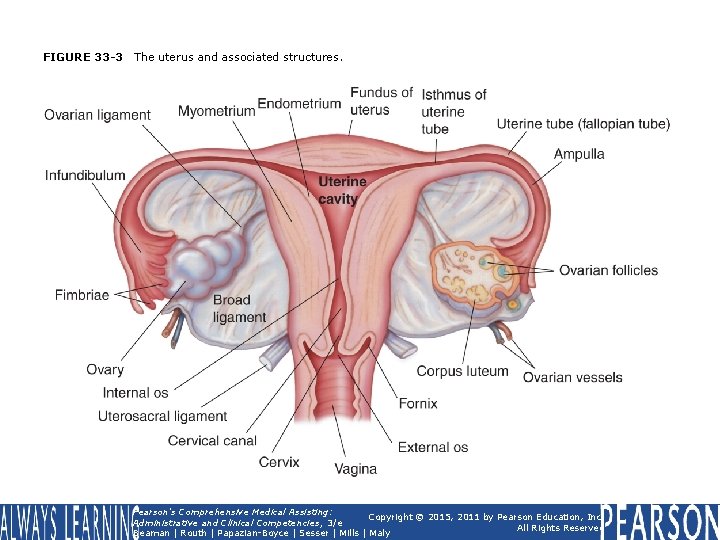 FIGURE 33 -3 The uterus and associated structures. Pearson's Comprehensive Medical Assisting: Copyright © FIGURE 33 -3 The uterus and associated structures. Pearson's Comprehensive Medical Assisting: Copyright ©