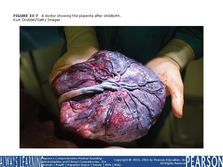 FIGURE 33 -7 A doctor showing the placenta after childbirth. Kurt Drubbel/Getty Images Pearson's FIGURE 33 -7 A doctor showing the placenta after childbirth. Kurt Drubbel/Getty Images Pearson's
