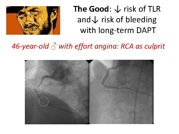 The Good: ↓ risk of TLR and↓ risk of bleeding with long-term DAPT 46