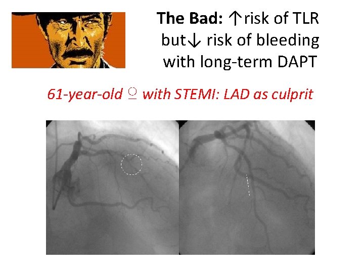 The Bad: ↑risk of TLR but↓ risk of bleeding with long-term DAPT 61 -year-old