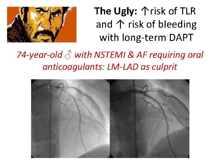 The Ugly: ↑risk of TLR and ↑ risk of bleeding with long-term DAPT 74