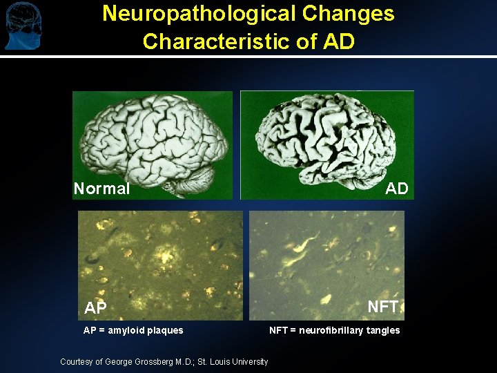 Neuropathological Changes Characteristic of AD Normal AP AP = amyloid plaques Courtesy of George