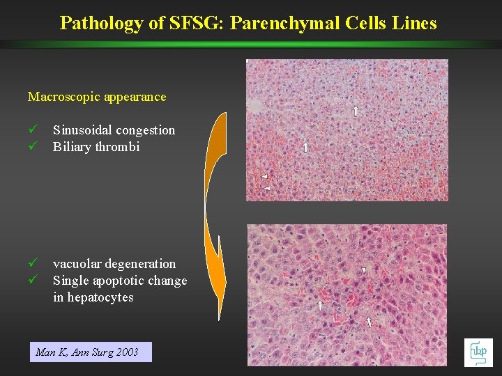Pathology of SFSG: Parenchymal Cells Lines Macroscopic appearance ü Sinusoidal congestion ü Biliary thrombi Pathology of SFSG: Parenchymal Cells Lines Macroscopic appearance ü Sinusoidal congestion ü Biliary thrombi