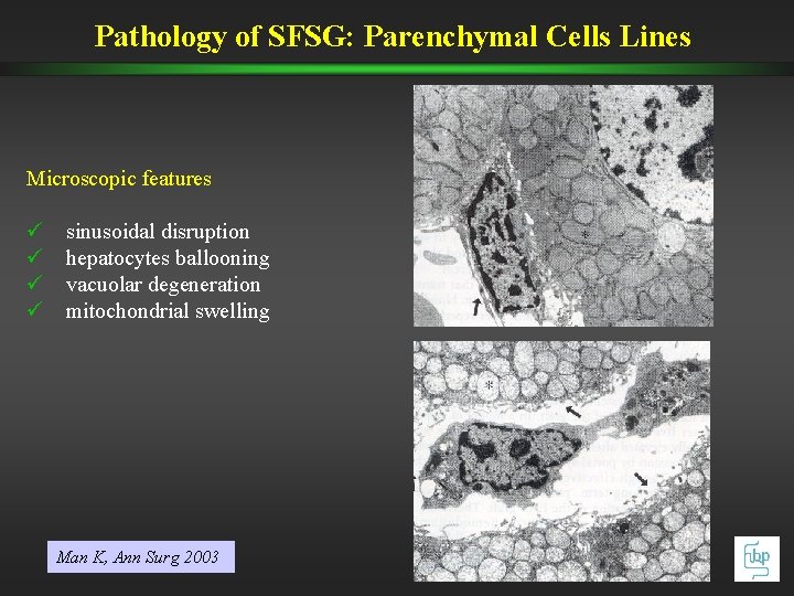 Pathology of SFSG: Parenchymal Cells Lines Microscopic features ü ü sinusoidal disruption hepatocytes ballooning Pathology of SFSG: Parenchymal Cells Lines Microscopic features ü ü sinusoidal disruption hepatocytes ballooning