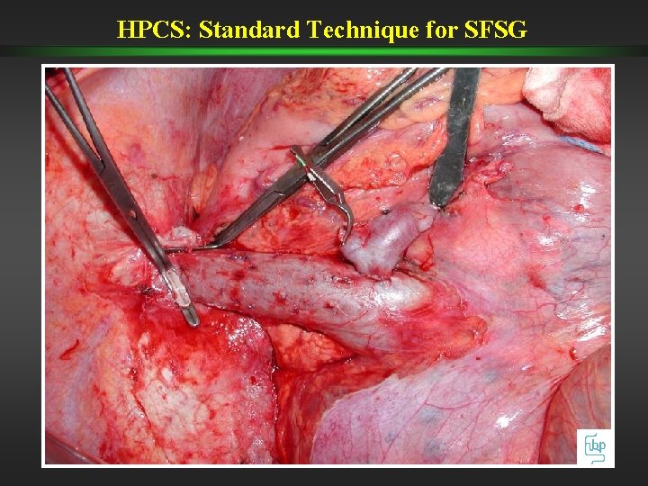 HPCS: Standard Technique for SFSG HPCS: Standard Technique for SFSG