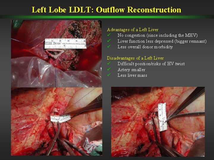 Left Lobe LDLT: Outflow Reconstruction Advantages of a Left Liver ü No congestion (since Left Lobe LDLT: Outflow Reconstruction Advantages of a Left Liver ü No congestion (since
