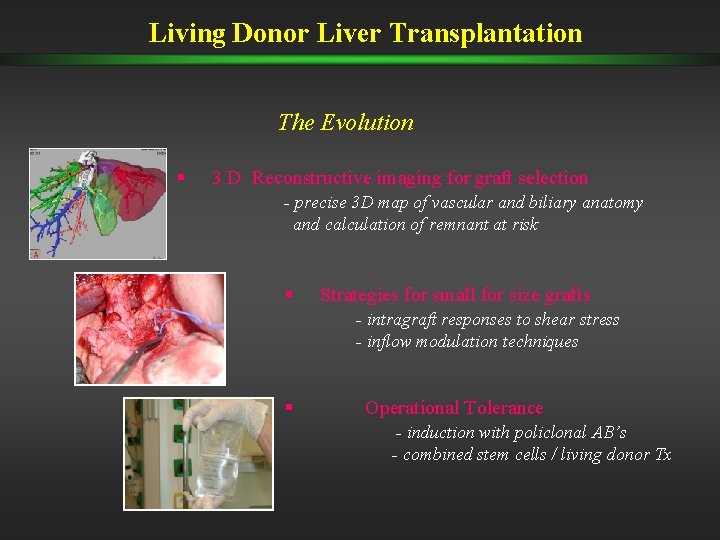 Living Donor Liver Transplantation The Evolution § 3 D Reconstructive imaging for graft selection Living Donor Liver Transplantation The Evolution § 3 D Reconstructive imaging for graft selection