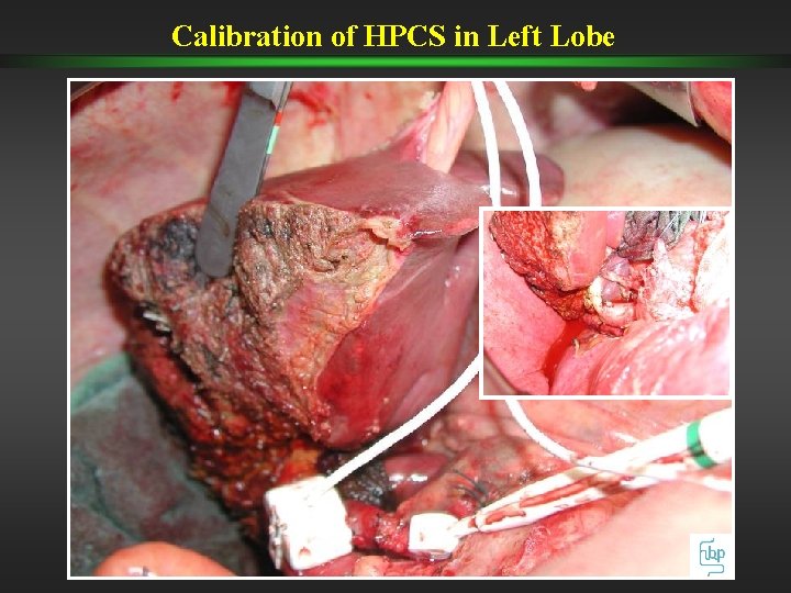 Calibration of HPCS in Left Lobe Calibration of HPCS in Left Lobe