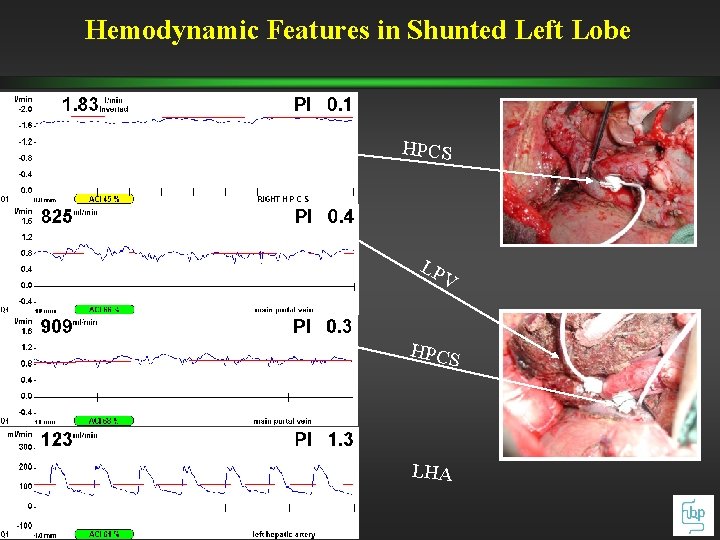 Hemodynamic Features in Shunted Left Lobe HPCS LP V HPCS LHA Hemodynamic Features in Shunted Left Lobe HPCS LP V HPCS LHA
