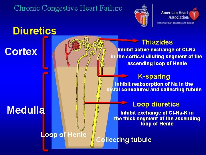 Chronic Congestive Heart Failure Diuretics Thiazides Cortex Inhibit active exchange of Cl-Na in the