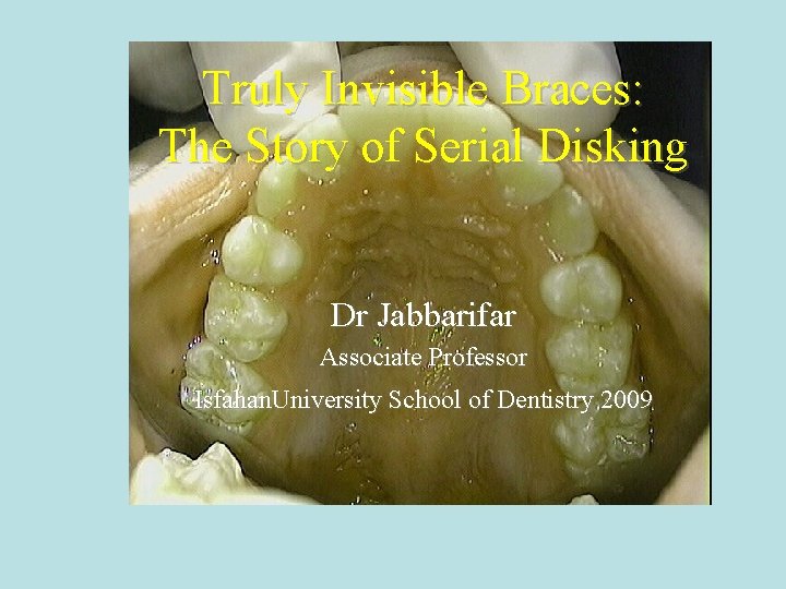 Truly Invisible Braces: The Story of Serial Disking Dr Jabbarifar Associate Professor Isfahan. University