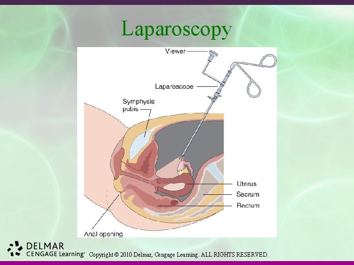 Laparoscopy Copyright © 2010 Delmar, Cengage Learning. ALL RIGHTS RESERVED. 