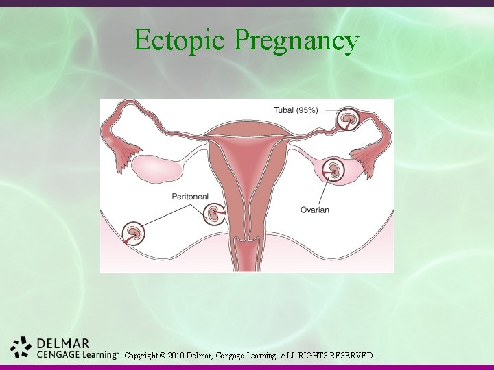 Ectopic Pregnancy Copyright © 2010 Delmar, Cengage Learning. ALL RIGHTS RESERVED. 