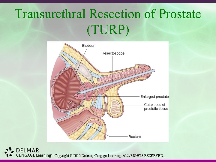 Transurethral Resection of Prostate (TURP) Copyright © 2010 Delmar, Cengage Learning. ALL RIGHTS RESERVED.