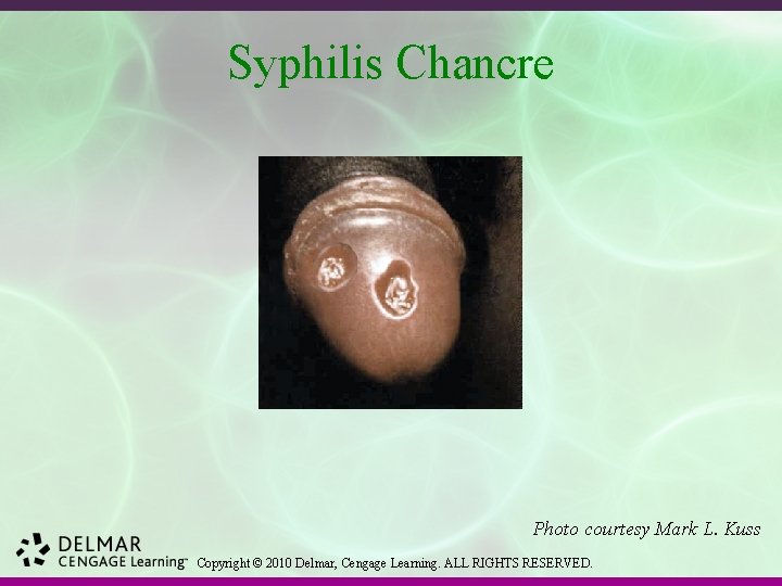 Syphilis Chancre Photo courtesy Mark L. Kuss Copyright © 2010 Delmar, Cengage Learning. ALL